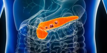 Revolution in cholesterol control - its accumulation favors the proliferation of tumor cells in pancreatic cancer