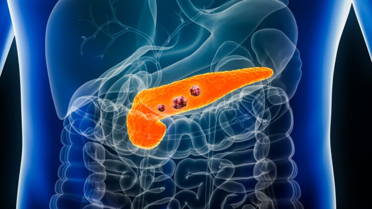 Revolution in cholesterol control - its accumulation favors the proliferation of tumor cells in pancreatic cancer