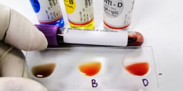 Neither A nor AB - Scientists Discover the MAL Blood Group, Solving a Medical Mystery of More Than 50 Years