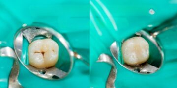 No fluoride or expensive implants—tooth regeneration finds an unexpected ally in sheep wool keratin