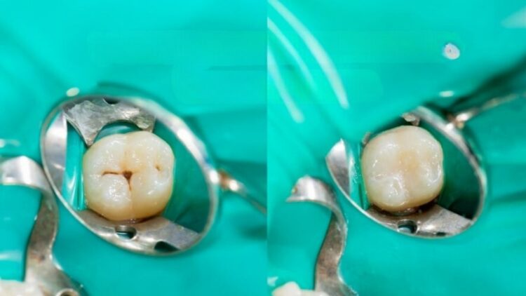 No fluoride or expensive implants—tooth regeneration finds an unexpected ally in sheep wool keratin