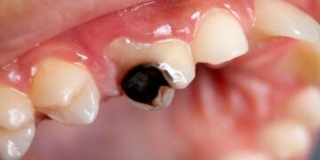 Goodbye to cavities forever—a natural molecule eliminates up to 90% of the bacterial plaque that causes them, according to a scientific dental study