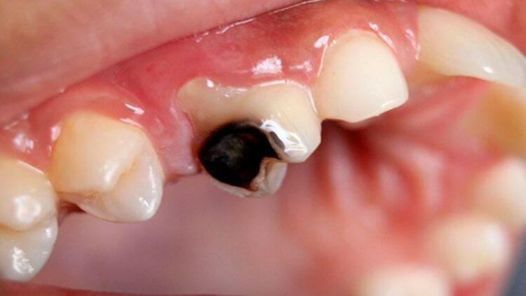 Goodbye to cavities forever—a natural molecule eliminates up to 90% of the bacterial plaque that causes them, according to a scientific dental study