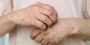 Shaun Yang, Director of the Department of Pathology at UCLA—no one will be able to live normally with this new disease that is spreading throughout the US