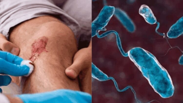 How an invisible lethal bacterium (Vibrio vulnificus) has paralyzed beach resorts in the US and set off health alarms even in Italy 1 How an invisible lethal bacterium (Vibrio vulnificus) has paralyzed beach resorts in the US and set off health alarms even in Italy