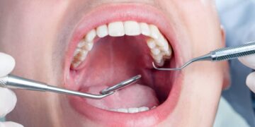 No pain, no swelling - that's how an overlooked cavity nearly cost this unfortunate man his life