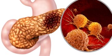 Farewell to mystery - scientists identify ALK7 receptor as key to rapid pancreatic cancer metastasis