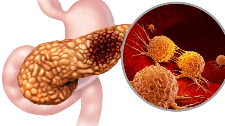 Farewell to mystery - scientists identify ALK7 receptor as key to rapid pancreatic cancer metastasis