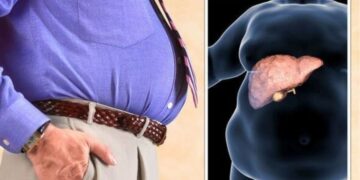 Dr. Saurabh Sethi, gastroenterologist and Harvard and Stanford graduate - "these are the 5 signs you can check yourself for fatty liver"